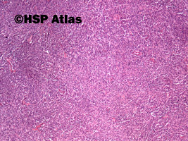 2. Oponiak atypowy (atypical meningioma), WHO II, 4x