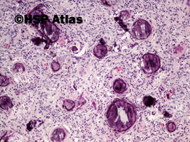 2. Oponiak piaszczakowaty (psammomatous meningioma), 10x