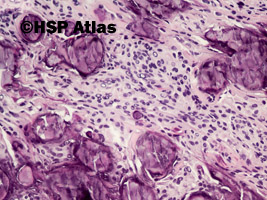 3. Oponiak piaszczakowaty (psammomatous meningioma), 20x