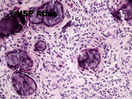 4. Oponiak piaszczakowaty (psammomatous meningioma), 20x