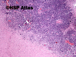 1. Metastatic small cell carcinoma, 4x