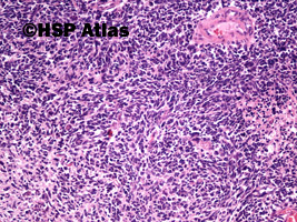 2. Przerzut raka dobnokomórkowego (metastatic small cell carcinoma), 10x