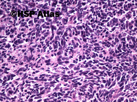 4. Przerzut raka dobnokomórkowego (metastatic small cell carcinoma), 20x