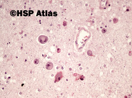 2. Toxoplazmoza mózgu (toxoplasmosis), 20x
