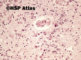 3. Toxoplazmoza mózgu (toxoplasmosis), 20x