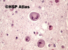 4. Toxoplazmoza mózgu (toxoplasmosis), 40x
