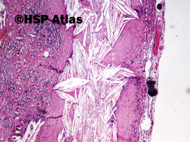 1. Ziarniniak żółtakowy splotu naczyniówkowego (xanthogranuloma of choroid plexus), 4x