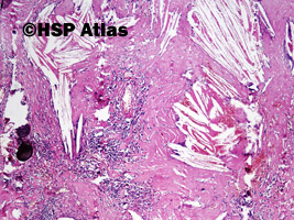 2. Ziarniniak żółtakowy splotu naczyniówkowego (xanthogranuloma of choroid plexus), 4x