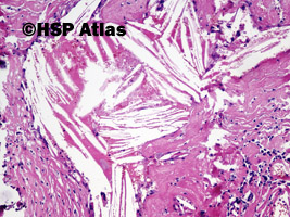 3. Ziarniniak żółtakowy splotu naczyniówkowego (xanthogranuloma of choroid plexus), 10x