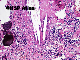 4. Ziarniniak żółtakowy splotu naczyniówkowego (xanthogranuloma of choroid plexus), 10x
