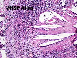 5. Ziarniniak żółtakowy splotu naczyniówkowego (xanthogranuloma of choroid plexus), 10x