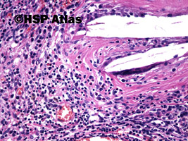 6. Ziarniniak żółtakowy splotu naczyniówkowego (xanthogranuloma of choroid plexus), 20x