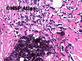 7. Ziarniniak żółtakowy splotu naczyniówkowego (xanthogranuloma of choroid plexus), 20x