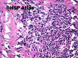 8. Ziarniniak żółtakowy splotu naczyniówkowego (xanthogranuloma of choroid plexus), 20x