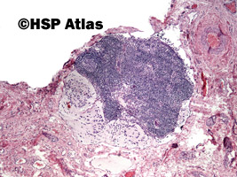 14. Neuroblastoma metastasis to lymph node, 4x