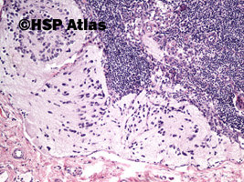 15. Neuroblastoma metastasis to lymph node, 10x
