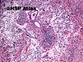 19. Metastatic neuroblastoma (liver), 10x