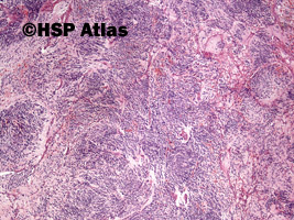 2. Neuroblastoma, 4x