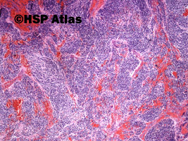 3. Neuroblastoma, 4x