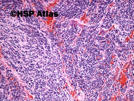7. Neuroblastoma, 10x