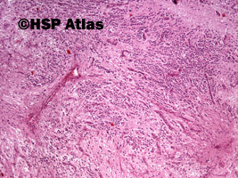 1. Nerwiak zarodkowy, typ dojrzewający (neuroblastoma, differentiating type), 4x