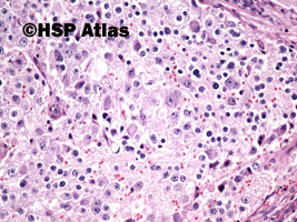 10. Nerwiak zarodkowy, typ dojrzewający (neuroblastoma, differentiating type), 20x