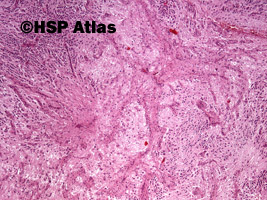 2. Nerwiak zarodkowy, typ dojrzewający (neuroblastoma, differentiating type), 4x