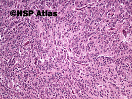 5. Neuroblastoma, differentiating type, 10x