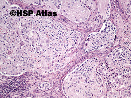 6. Nerwiak zarodkowy, typ dojrzewający (neuroblastoma, differentiating type), 10x
