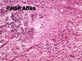 7. Nerwiak zarodkowy, typ dojrzewający (neuroblastoma, differentiating type), 10x