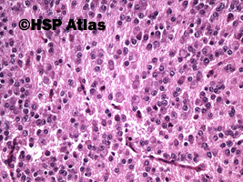 8. Nerwiak zarodkowy, typ dojrzewający (neuroblastoma, differentiating type), 20x