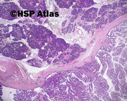 1. Intraductal papillary mucinous neoplasm - IPMN