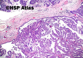 2. Intraductal papillary mucinous neoplasm - IPMN