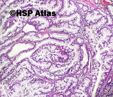 3. Intraductal papillary mucinous neoplasm - IPMN