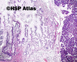 4. Intraductal papillary mucinous neoplasm - IPMN