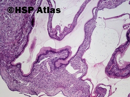 2. Nowotwór śluzowy torbielowaty (mucinous cystic neoplasm, MCN), 4x