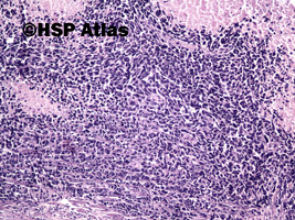 2. Rak neuroendokrynny drobnokomórkowy (neuroendocrine small cell carcinoma), 10x