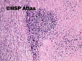 3. Rak neuroendokrynny drobnokomórkowy (neuroendocrine small cell carcinoma), 10x