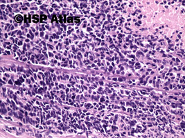 4. Neuroendocrine small cell carcinoma, 20x