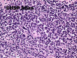 5. Rak neuroendokrynny drobnokomórkowy (neuroendocrine small cell carcinoma), 20x