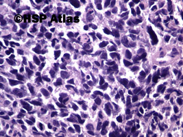 7. Rak neuroendokrynny drobnokomórkowy (neuroendocrine small cell carcinoma), 40x