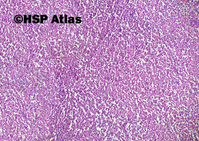 1. Lity pseudobrodawkowy nowotwór (solid-pseudopapillary neoplasm)