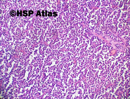 3. Lity pseudobrodawkowy nowotwór (solid-pseudopapillary neoplasm)