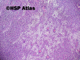 4. Lity pseudobrodawkowy nowotwór (solid-pseudopapillary neoplasm)