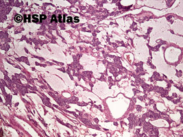 2. Parathyroid gland hyperplasia, 4x