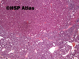 1. Rozrost przytarczyc - rozrost komórek oksyfilnych (parathyroid gland hyperplasia - oncocytic cells hyperplasia), 4x