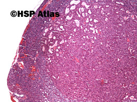 2. Rozrost przytarczyc - rozrost komórek oksyfilnych (parathyroid gland hyperplasia - oncocytic cells hyperplasia), 4x