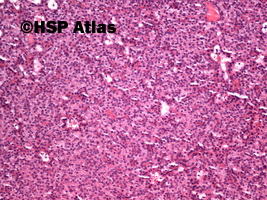 3. Parathyroid gland hyperplasia - oncocytic cells hyperplasia, 10x