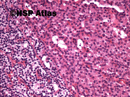 4. Rozrost przytarczyc - rozrost komórek oksyfilnych (parathyroid gland hyperplasia - oncocytic cells hyperplasia), 20x