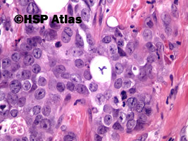 11. Rak anaplastyczny (anaplastic carcinoma), 40x